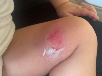 Burn on toddler's leg.
