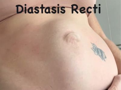 Jana Pittman shows her postpartum stomach, including her diastasis recti.