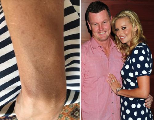 Photos of Ms Landry's arm, bruised during an alleged fight with Mr Bell. The pair are pictured here in happier times in 2010. Source: AAP