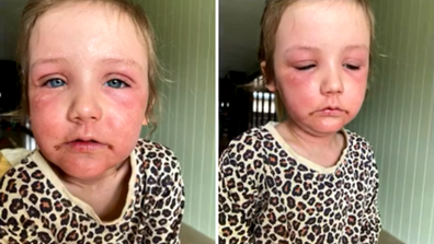 Aussie parents on daughter's struggle with incurable skin condition