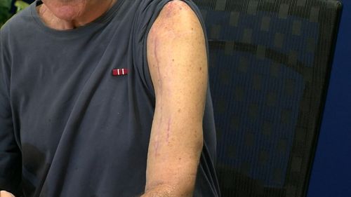 Mr Walker still wears the scars from that day. (9NEWS)