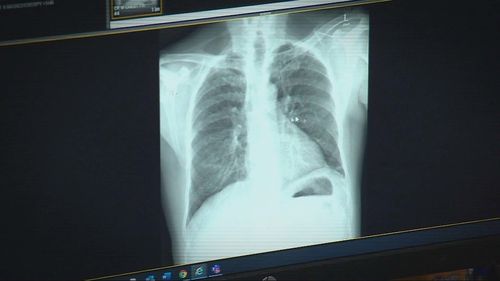 Workers in underground tunnels expected to contract silicosis, new study finds