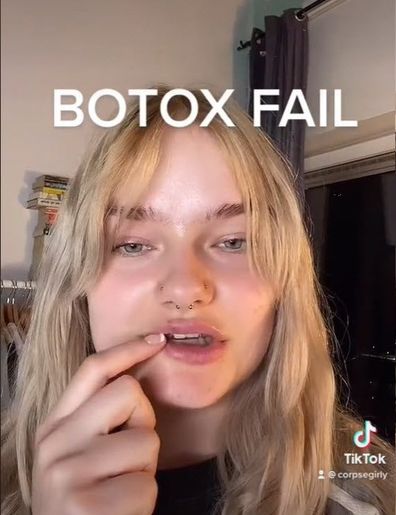 Botox fail shared on TikTok