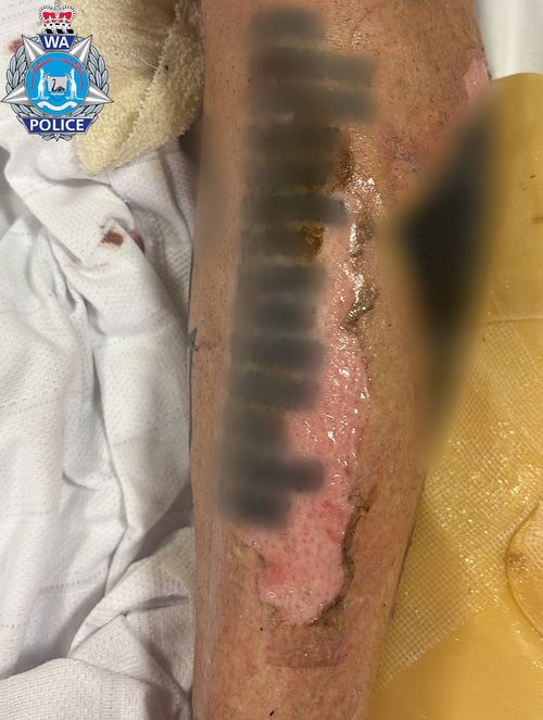 WA Police released some images showing the extent of the man's injuries.