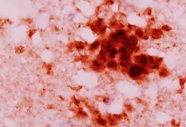 Creutzfeldt-Jakob disease is caused by which infectious agent?
