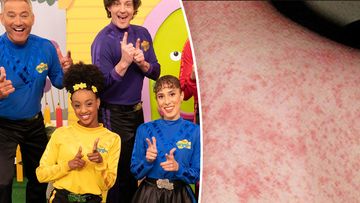 The Wiggles and a measles patient