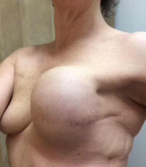 Aussie breast cancer survivors are upset over Facebook's ban on photos of their mastectomies and reconstructions