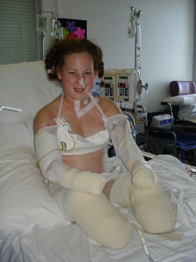 Mel Groenewold in hospital after losing her hands and feet.