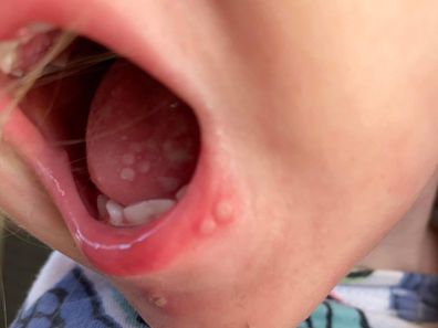 Mum shares shocking photos of daughter's cold sore outbreak. Warns parents 'do not kiss babies'