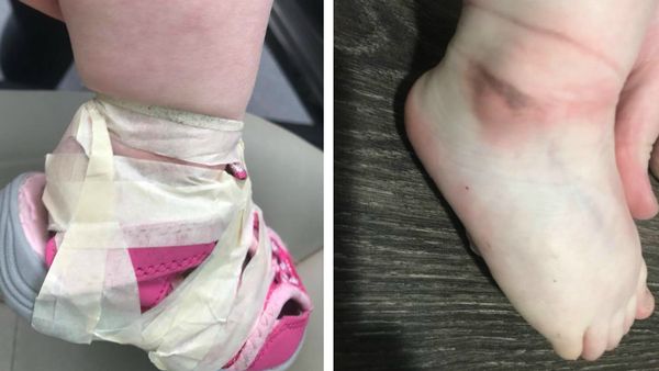 Mum furious after daughter left with 'strap marks' after Clarks shoe  fitting - Hull Live