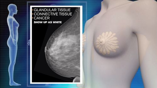 Scans of higher-density breasts can conceal cancers.