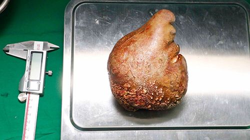 The world's largest kidney stone on display in Sri Lanka.