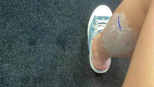 Becky Zhao's calves were marked as she waited for them to be injected with botulinum toxin.