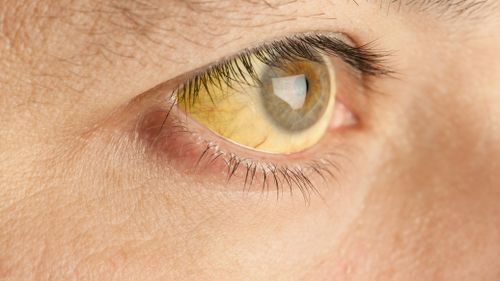 Chelsey was suffering from jaundice, which makes the eyes appear yellow. (Stock photo)