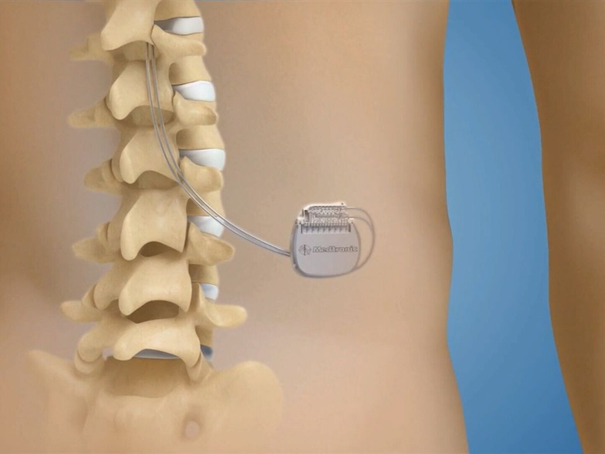 Chronic back pain now being treated with world's smallest battery-powered  implant