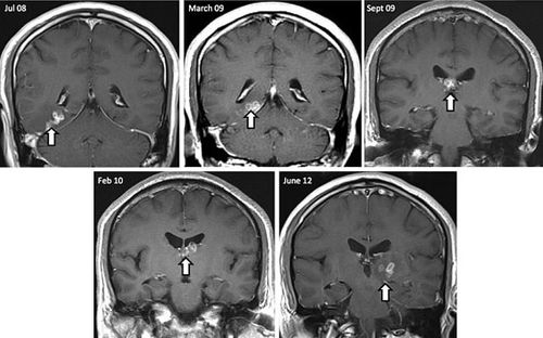 Parasitic 10cm tapeworm lived in man’s brain for four years