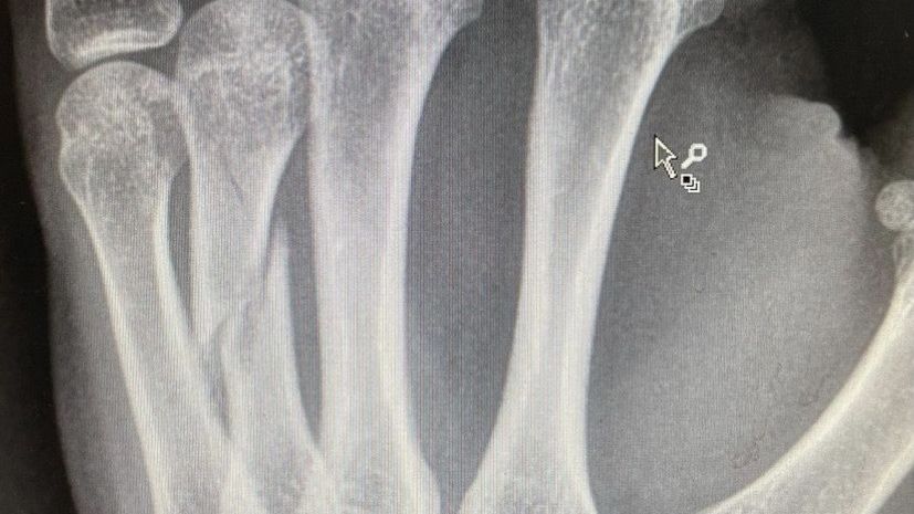 Shayna Jack&#x27;s X-rays shows a nasty spiral break in her fourth metacarpal.