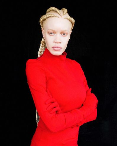 Albino Model Breaks Beauty Barriers 9style