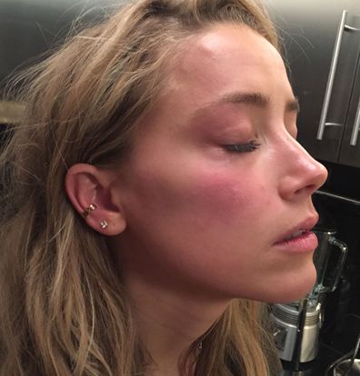 This handout photo provided by London High Court shows a photo used in evidence of Amber Heard with marks on her face that she says were inflicted by Johnny Depp, in May 2016.