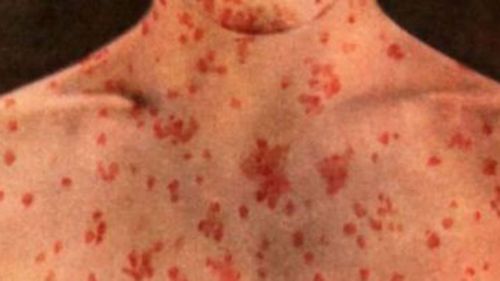 Measles symptoms include fever, sore eyes and a cough followed three or four days later by a red, blotchy rash spreading from the head and neck to the rest of the body.