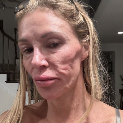 Brandi Glanville face disfigurement