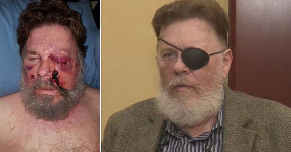 US man loses an eye after e-cigarette 'explodes in his face'