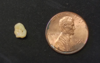 A Reddit user was shocked when they woke up to find a tonsil stone ...