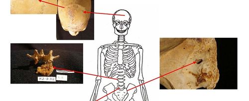 Ancient Egyptian cemetery help researchers understand rise of cancer