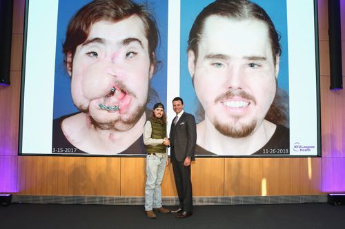 Cameron stands with his doctor in front of before and after surgery images shown to the audience. The surgery, 11 months ago, took 25 hours  to complete.
