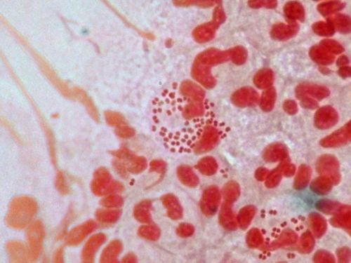 A strain of 'superbug' gonorrhoea has been reported in several countries including Australia, the United Kingdom, France, Japan and Spain.