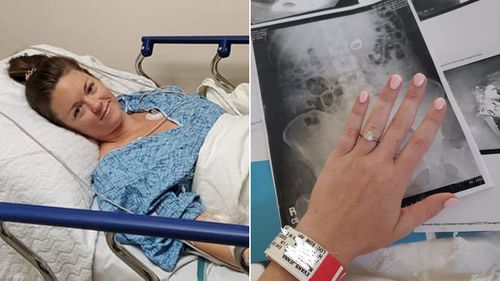 Woman swallows engagement ring in her sleep, needs surgery