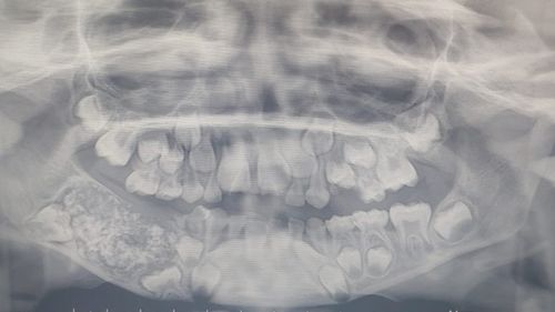 This x-ray shows the inside of the mouth of a boy who was found to have an extra 526 teeth.