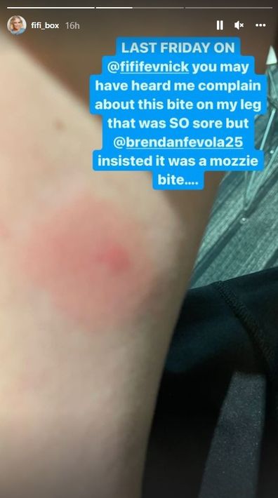 Fifi Box on antibiotics after being bitten by a spider while in bed