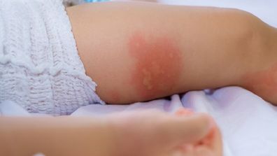 Hives are one common indication of food allergies
