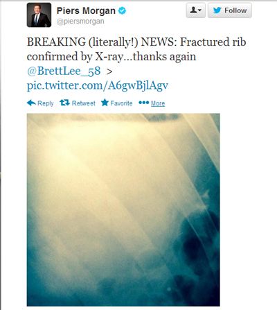 Piers Morgan tweeted this pic of his broken rib