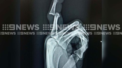 An x-ray scan of Penrith Panthers star Trent Merrin's finger shows the damage done in a horrific injury he sustained during team warm-up preparations. Picture: Supplied.