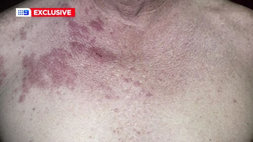 Shingles can appear as a blistering rash in those who've previously had chickenpox.