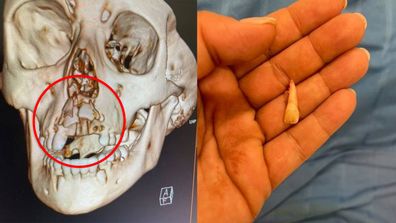 Left: X-ray, Right: loose tooth in hand.