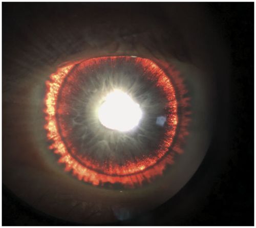 A Texas man had a rare condition that made his eye look like Lord of the Rings' Eye of Sauron. 