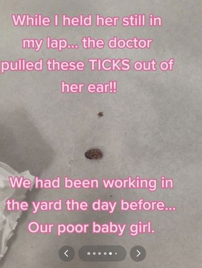 Mum finds ticks in toddler's ears tiktok