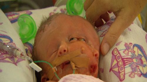 An Australian couple made history after giving birth to conjoined twins that shared one body and two faces. (Supplied)