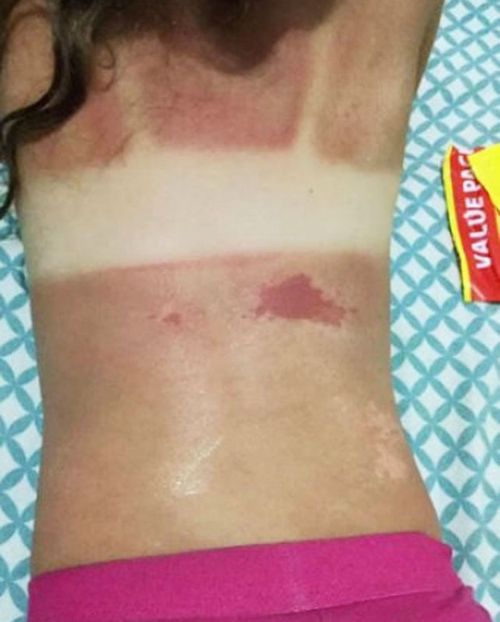 Hundreds of Banana Boat's customers flooded the company Facebook page with complaints of sunburn last summer. (Facebook)