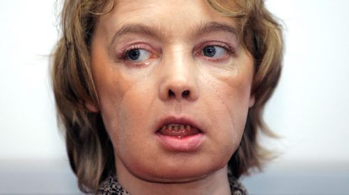Recipient of world's first face transplant, Isabelle Dinoire, dies