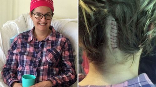 Joanne Warren, pictured just days after her brain surgery to remove the cyst.