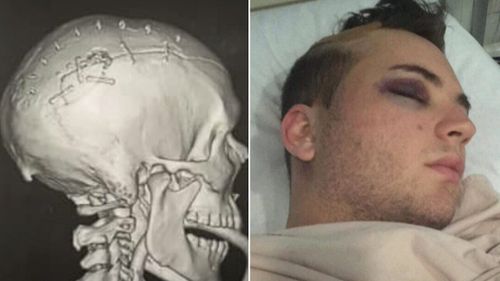 The IT consultant suffered skull fractures and bleeding on the brain. (9NEWS)