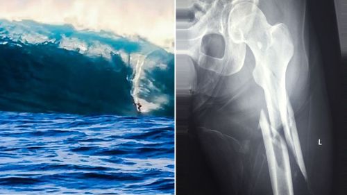 Professional surfer breaks leg in WA 'swell of the decade'