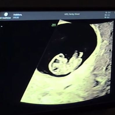 Sophie Habboo and Jamie Laing baby sonogram