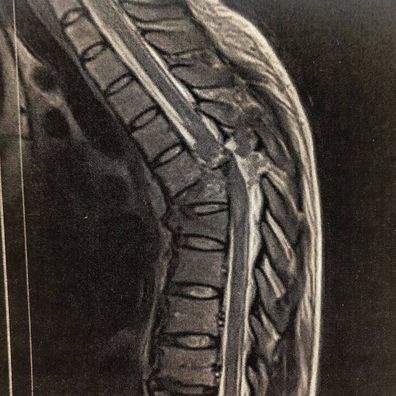 An X-ray shows the damage to Christina Vithoulkas's spine after the crash.