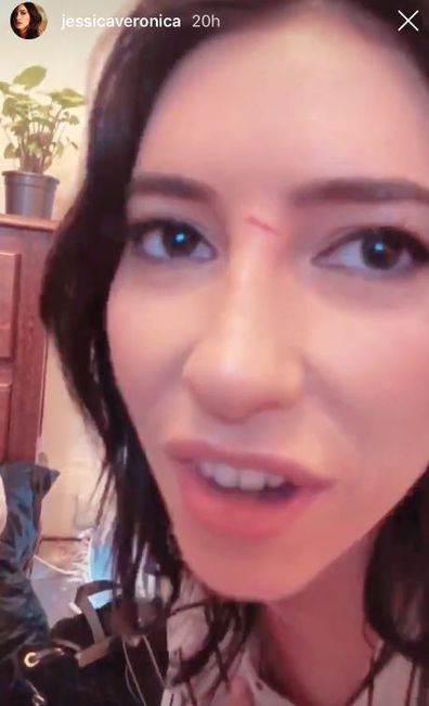 Jessica Origliasso  and Lisa Origliasso from The Veronicas cut on nose following accident