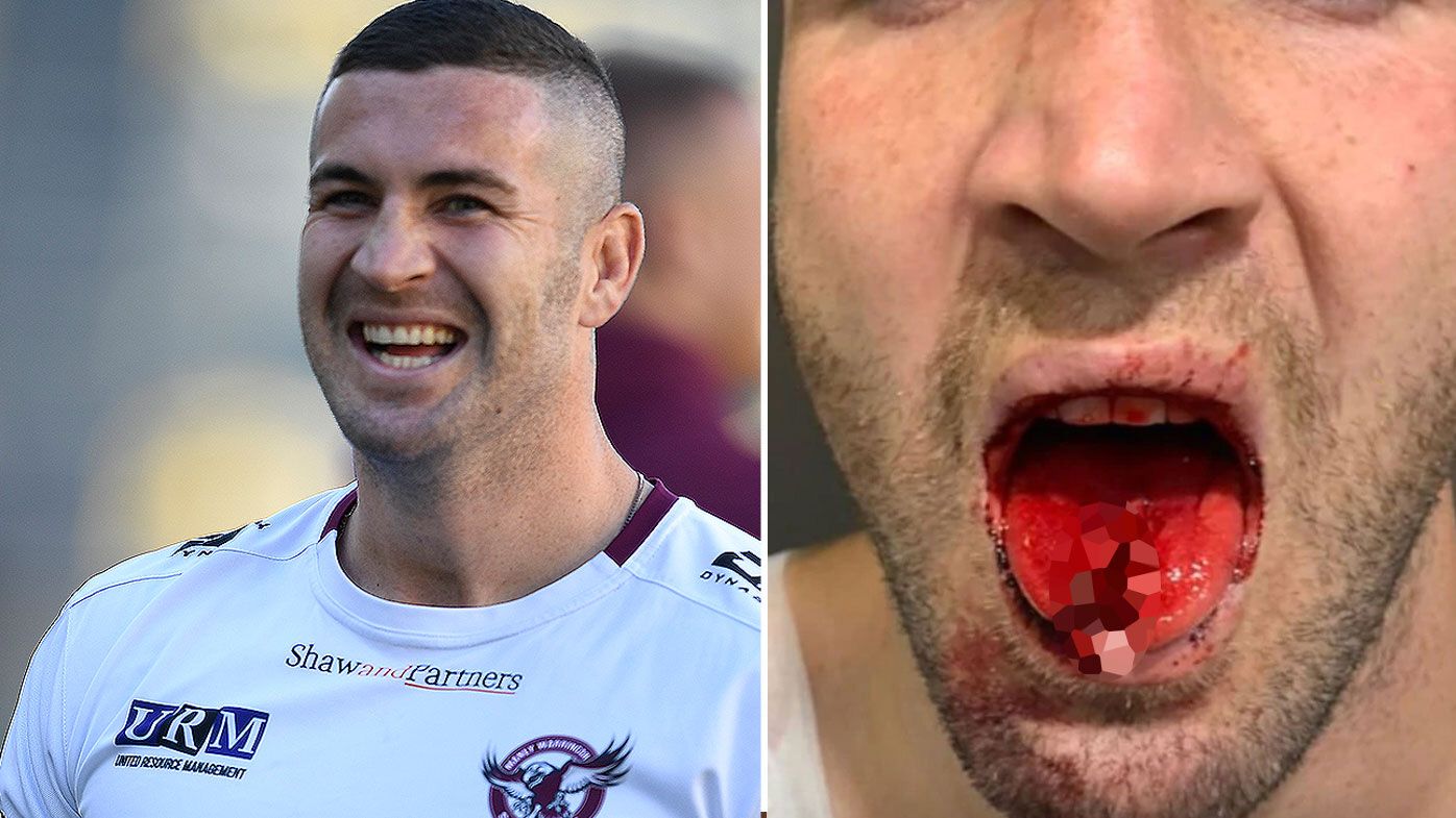 GRAPHIC WARNING: Manly's Joel Thompson suffers gruesome cut tongue against Knights